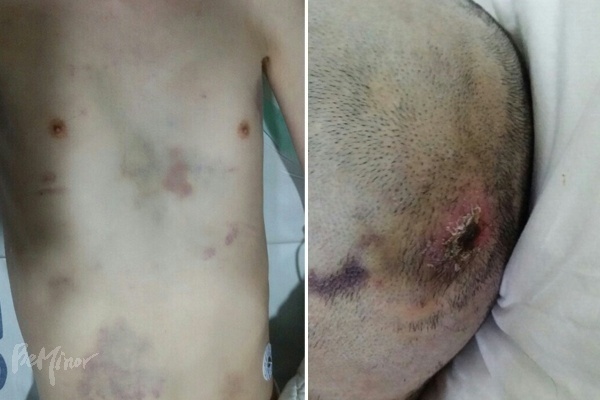 인천 해바라기 시설 이아무개씨가 시설 내 폭행으로 온 몸에 피멍이 든 모습. 그는 폭행을 당한 후 한달만에 사망했다.