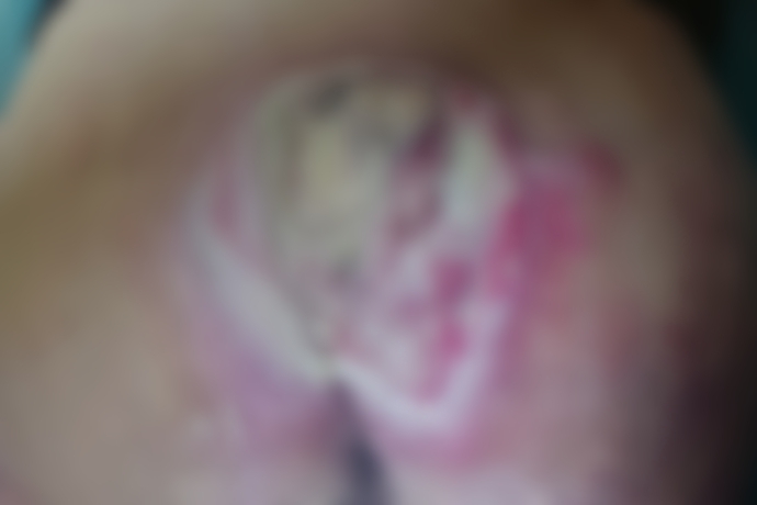 김동훈 씨(가명)의 꼬리뼈 부위에 발생한 욕창. (사진제공=김동훈/당사자의 요청에 따라 게시). 