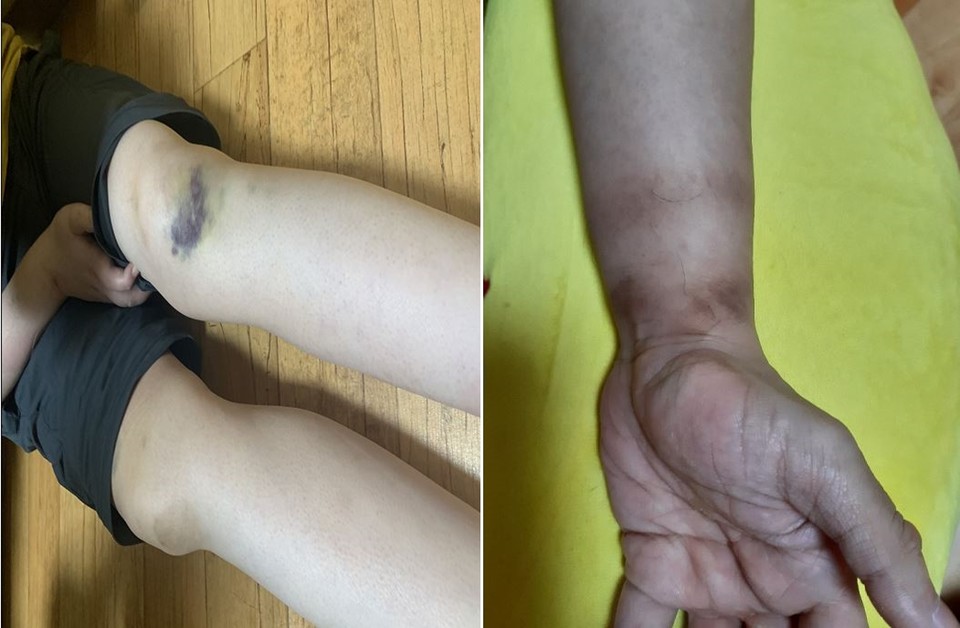 강남구 조사결과 거주인 2명의 팔과 다리에 커다란 멍 자국이 발견됐다. 종사자들은 자해흔적이라고 했지만, 피해 거주인의 개인관찰기록지에는 자해에 관한 기록이 남아 있지 않았다. 사진 장혜영 의원실 제공