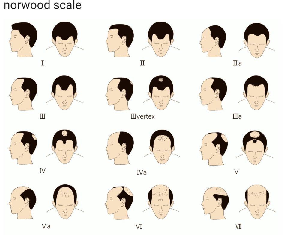 탈모에 대한 표준 분류법인 노우드 스케일(Norwood scale). ‘질병’의 경계는 유동적이며, 대머리가 ‘질병’으로 등록되었던 과정 자체가 논쟁과 타협의 산물이었다. 사진 https://www.freedomclinictoronto.com/about-hair-and-hair-loss/types-of-hair-loss/
