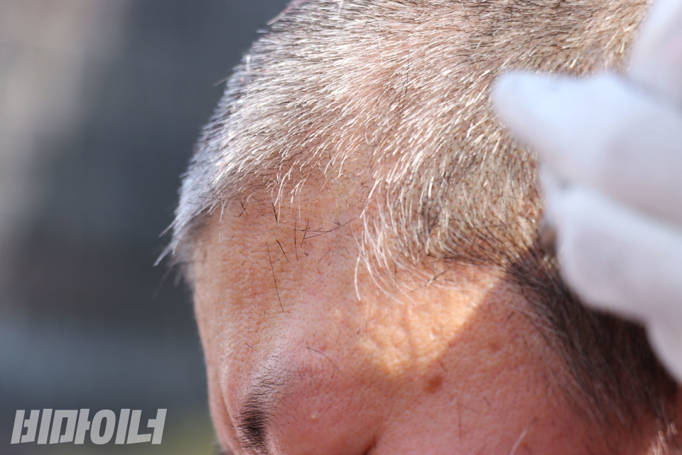 붉게 염색한 머리칼이 모두 잘려 나간 이수미 씨의 머리. 사진 강혜민